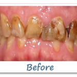 Dental Implants - Before